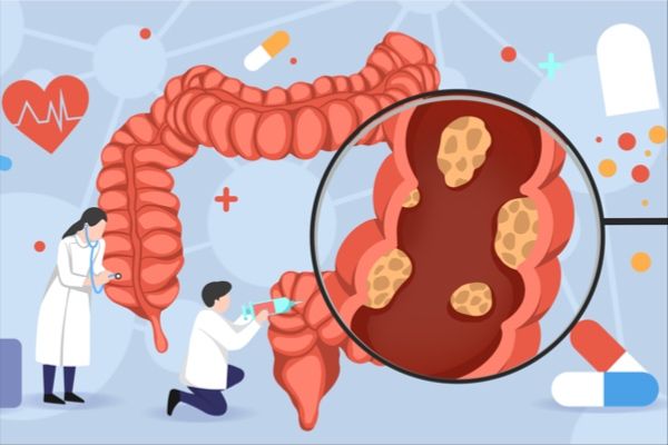 Takeda Gets Green Light from U.S. FDA to Market FRUZAQLA™ (fruquintinib) for a Pre-treated Type of Advanced Colon Cancer