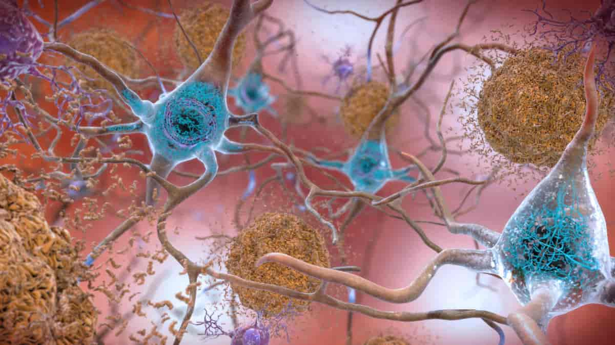 Alzheimers sykdom – Store medisinske leksikon